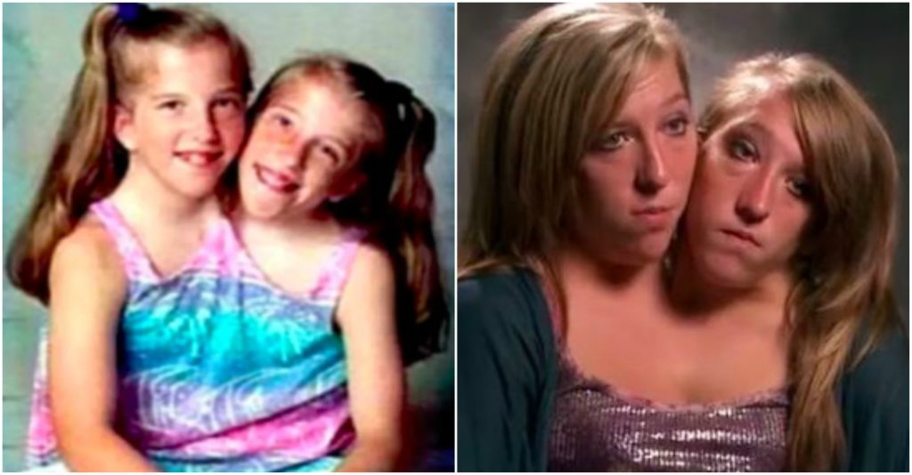 Here’s What Conjoined Twins Abby And Brittany Hensel Look Like Today ...